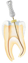 Endodontie in der Zahnarztpraxis Dr. Eichinger, W&uuml;rzburg