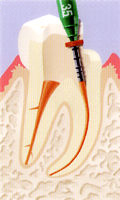 Endodontie in der Zahnarztpraxis Dr. Eichinger, W&uuml;rzburg