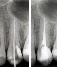 Endodontie in der Zahnarztpraxis Dr. Eichinger, W&uuml;rzburg